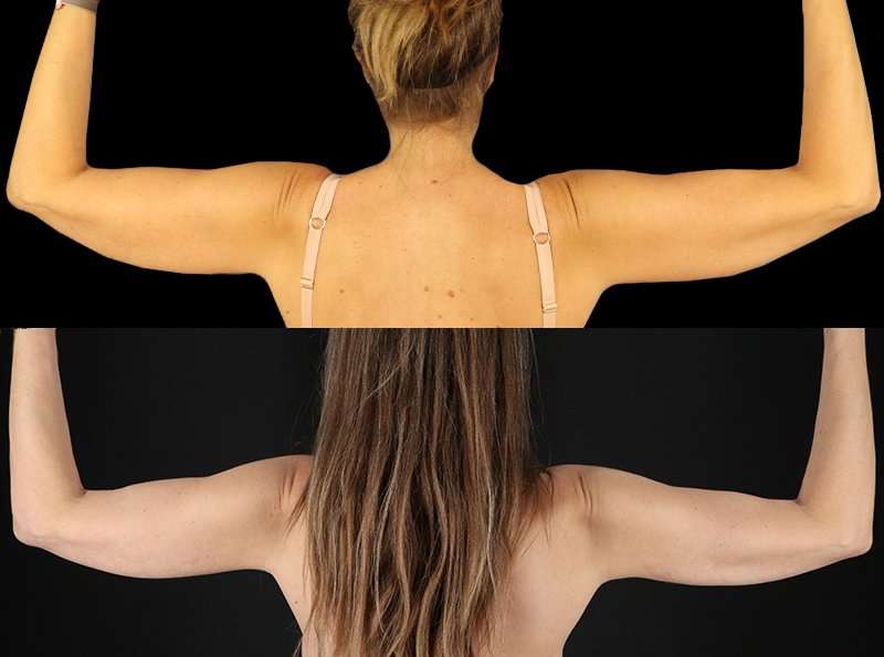 Liposuction Before & After Patient #1256