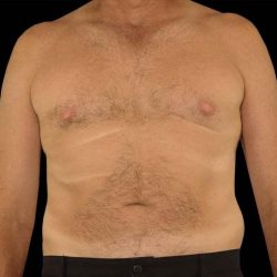 Liposuction Before & After Patient #1270