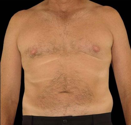 Liposuction Before & After Patient #1270