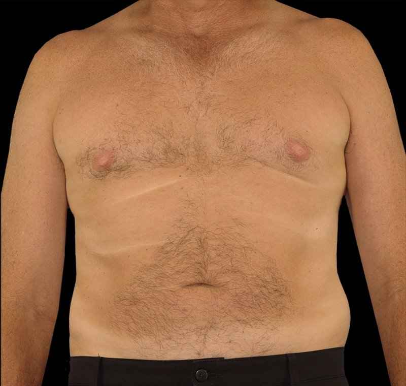 Liposuction Before & After Patient #1270