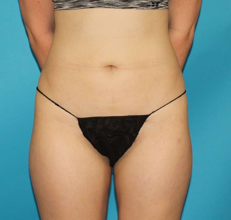 Liposuction Before & After Patient #1281