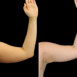 Liposuction Before & After Patient #1284