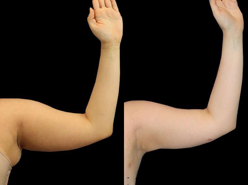 Liposuction Before & After Patient #1284