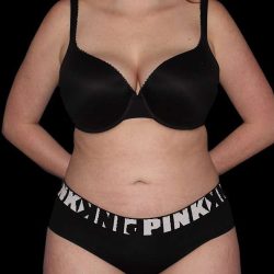 Liposuction Before & After Patient #1298