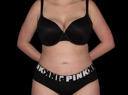 Liposuction Before & After Patient #1298