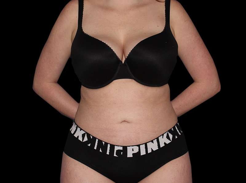 Liposuction Before & After Patient #1298