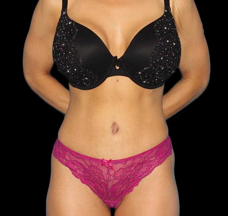 Liposuction Before & After Patient #1310