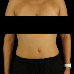 Liposuction Before & After Patient #1332