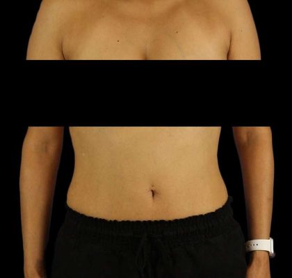 Liposuction Before & After Patient #1332