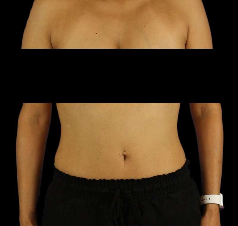 Liposuction Before & After Patient #1332