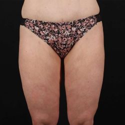 Liposuction Before & After Patient #1337