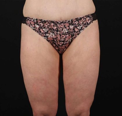 Liposuction Before & After Patient #1337