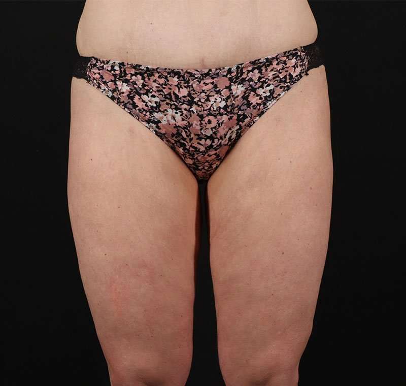 Liposuction Before & After Patient #1337