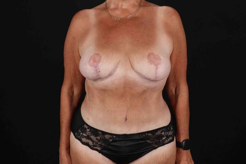 Liposuction Before & After Patient #1348