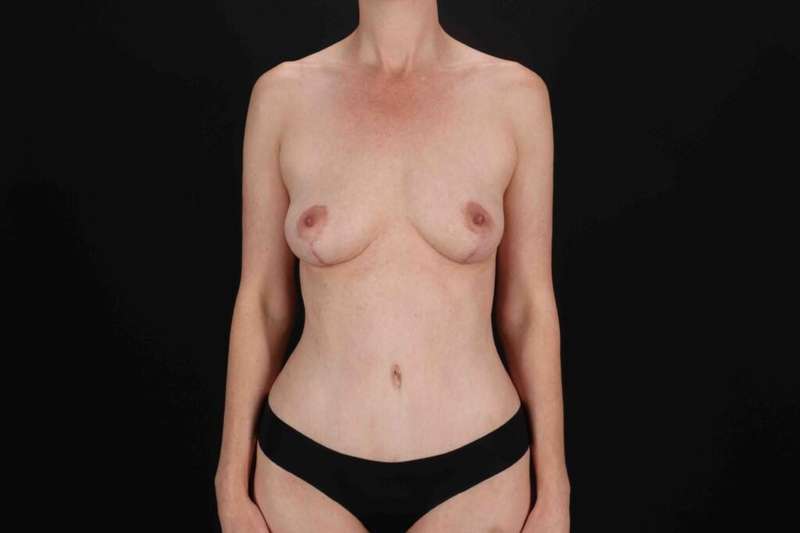 Liposuction Before & After Patient #1374