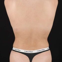 Liposuction Before & After Patient #1414