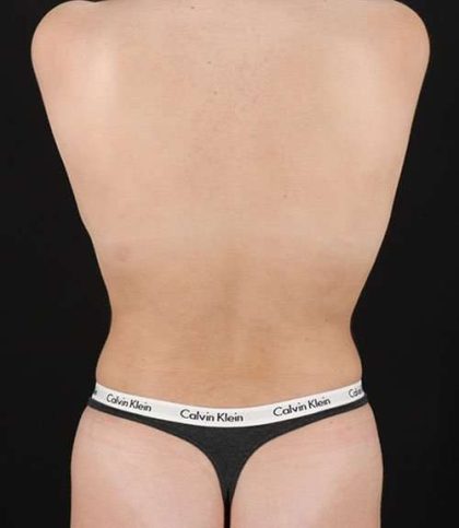Liposuction Before & After Patient #1414