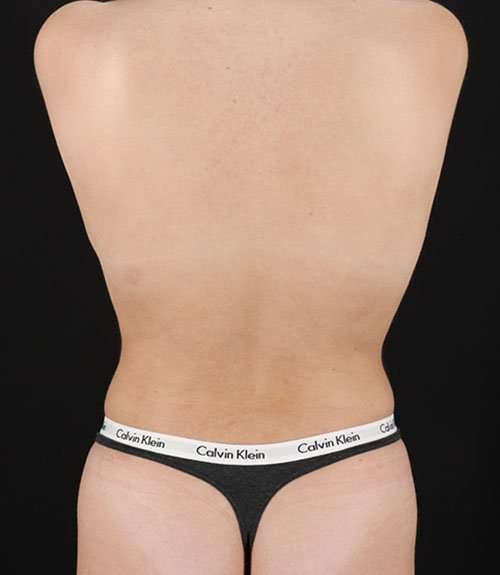 Liposuction Before & After Patient #1414