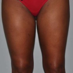 Liposuction Before & After Patient #1419