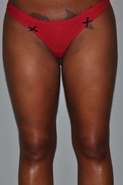 Liposuction Before & After Patient #1419