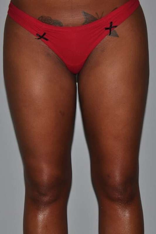 Liposuction Before & After Patient #1419