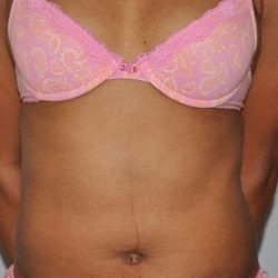 Liposuction Before & After Patient #1425