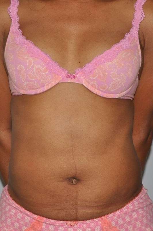 Liposuction Before & After Patient #1425