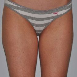 Liposuction Before & After Patient #1428