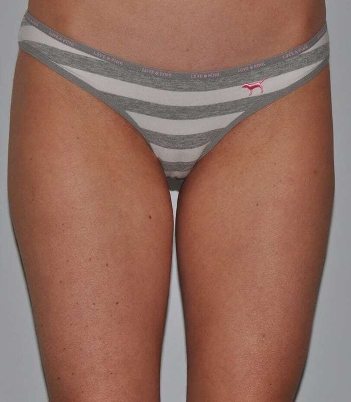 Liposuction Before & After Patient #1428