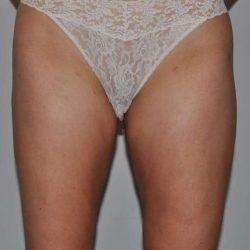 Liposuction Before & After Patient #1433