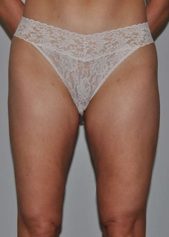 Liposuction Before & After Patient #1433