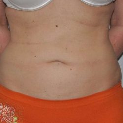 Liposuction Before & After Patient #1439