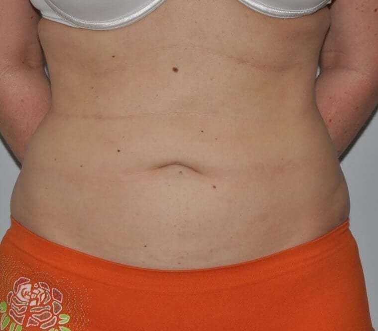 Liposuction Before & After Patient #1439