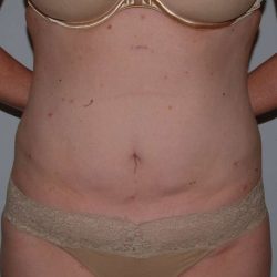 Liposuction Before & After Patient #1445
