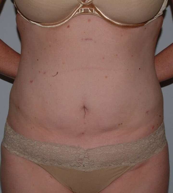 Liposuction Before & After Patient #1445
