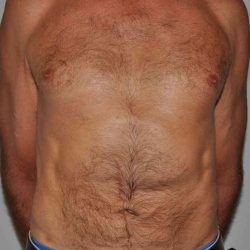 Liposuction Before & After Patient #1450