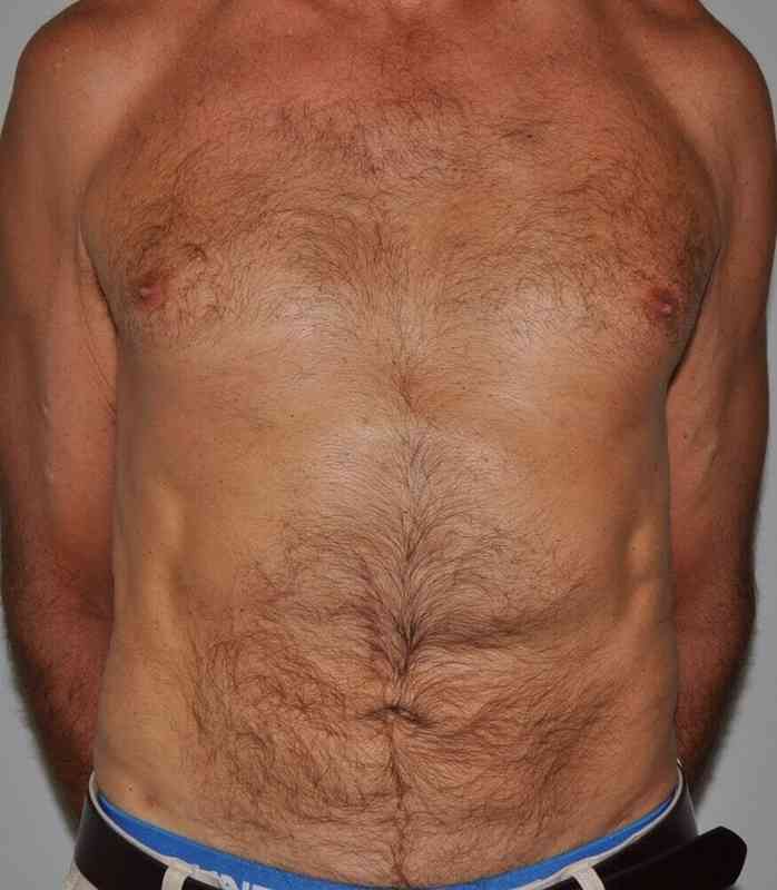 Liposuction Before & After Patient #1450