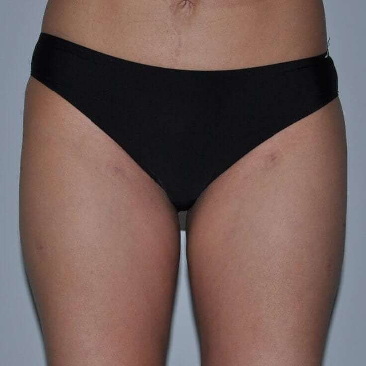 Liposuction Before & After Patient #1455