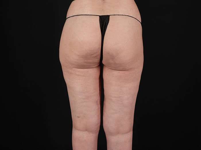 Cellulite Treatment Before & After Patient #546