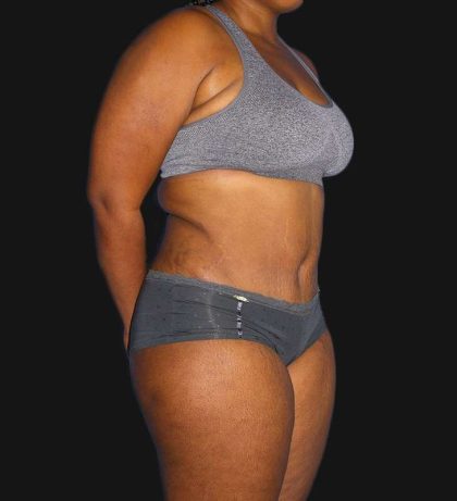 Abdominoplasty (Tummy Tuck) Before & After Patient #568