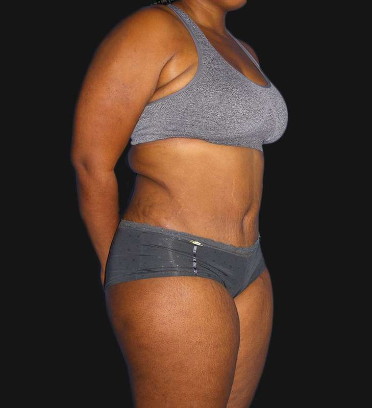 Abdominoplasty (Tummy Tuck) Before & After Patient #568