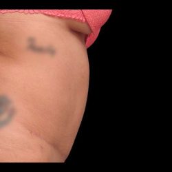 Abdominoplasty (Tummy Tuck) Before & After Patient #670