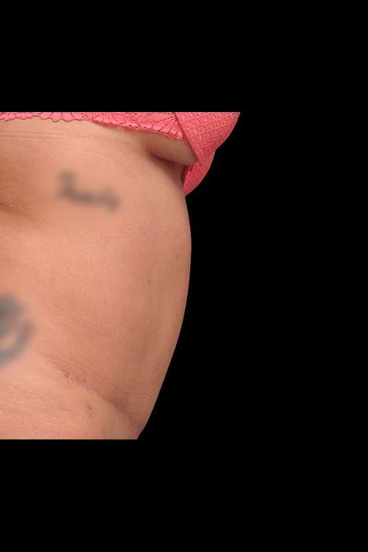 Abdominoplasty (Tummy Tuck) Before & After Patient #670