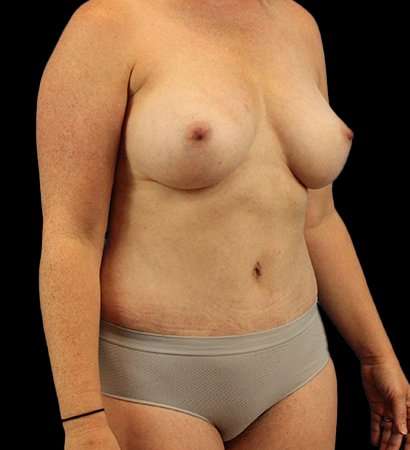 Mommy Makeover Before & After Patient #1738