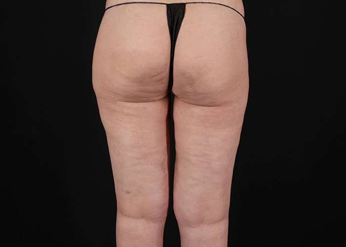 Thigh Lift Before & After Patient #1756