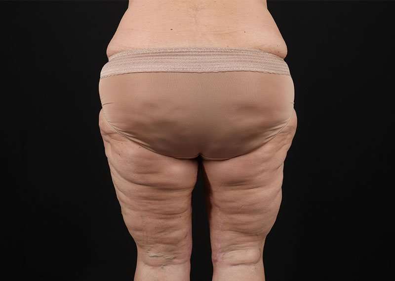 Thigh Lift Before & After Patient #1762