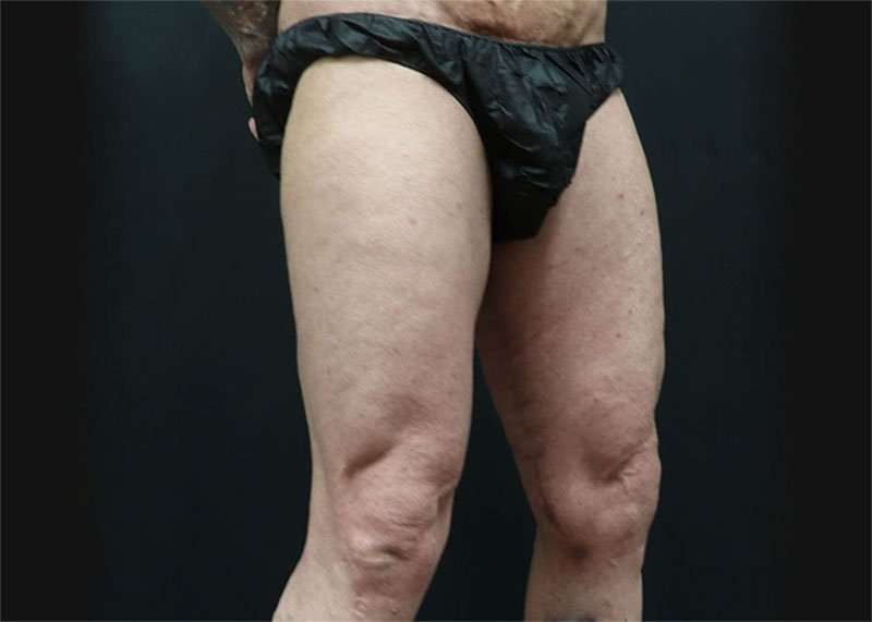 Thigh Lift Before & After Patient #1776