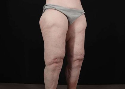 Thigh Lift Before & After Patient #1790