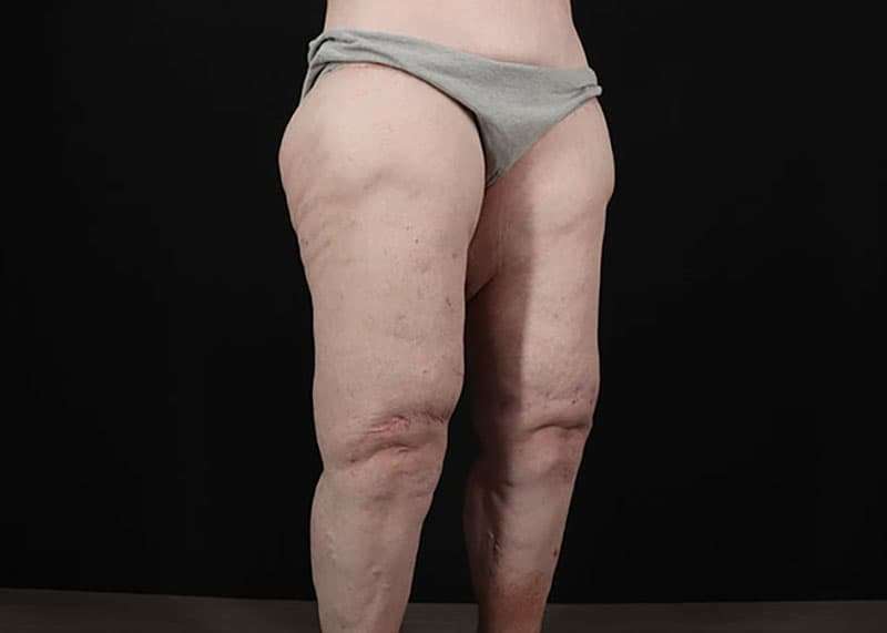 Thigh Lift Before & After Patient #1790