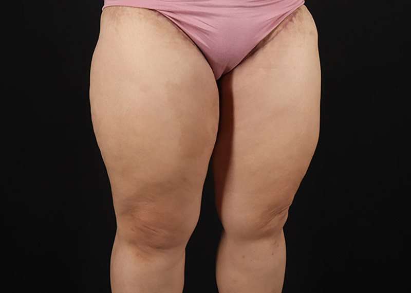 Thigh Lift Before & After Patient #1804